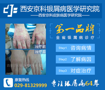 郑州市治疗银屑病最好的医院